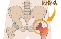 股骨头坏死有什么好办法治疗吗？中医成果获广泛检验