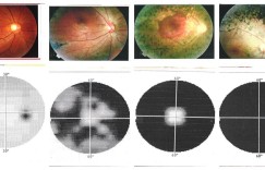 手术治疗“视网膜色素变性”历程回顾 愿失明不是必然 